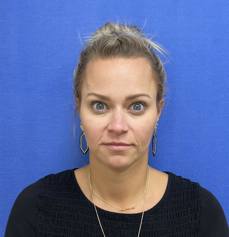 BOTOX® Before & After Gallery - Patient 146222245 - Image 4