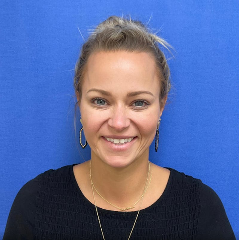 BOTOX® Before & After Gallery - Patient 146222245 - Image 6