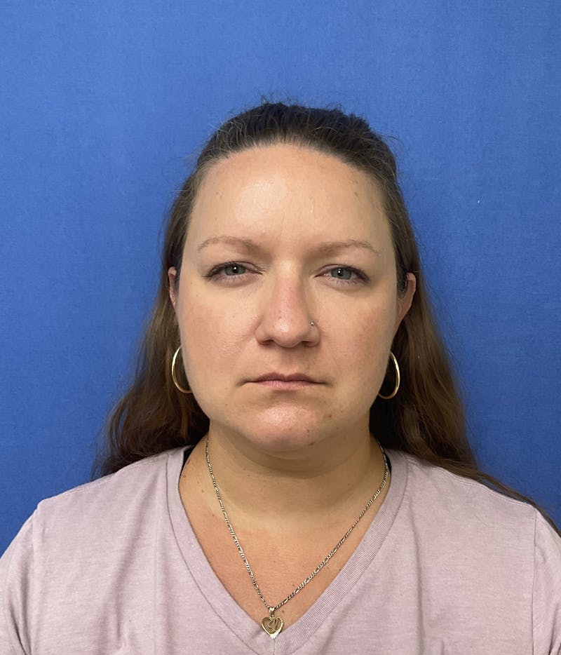 Kellee Murray, DNP Before & After Gallery - Patient 146222241 - Image 2