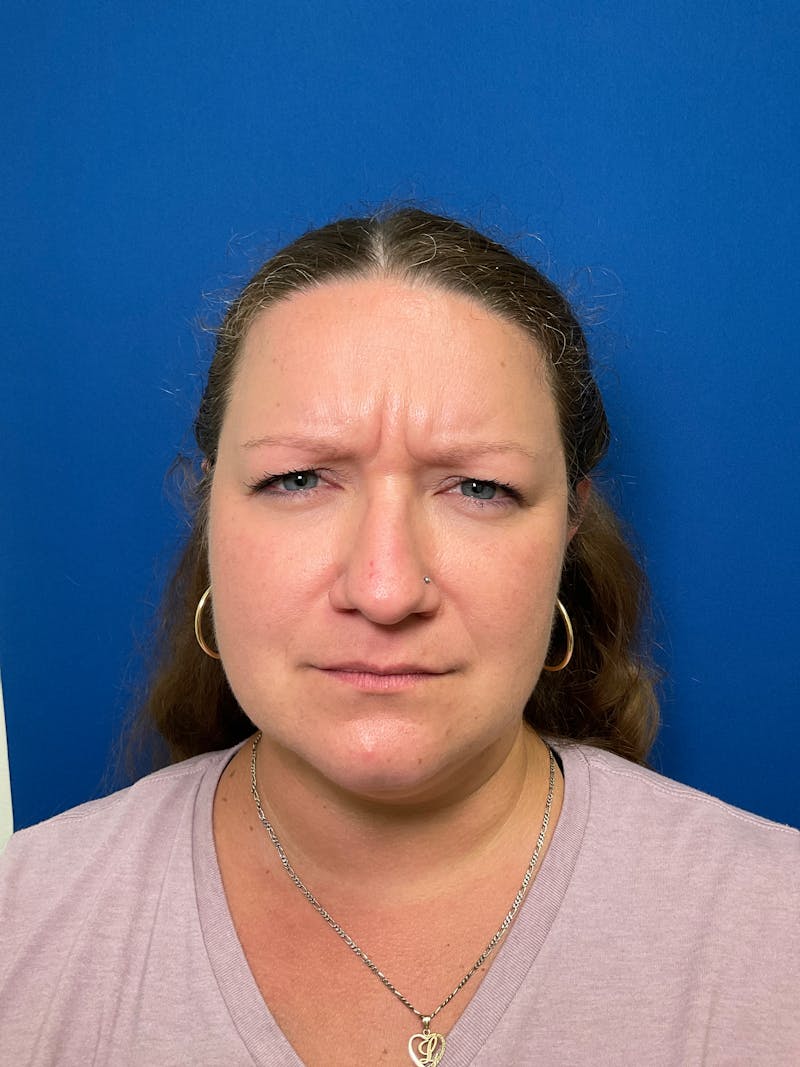 Kellee Murray, DNP Before & After Gallery - Patient 146222241 - Image 1