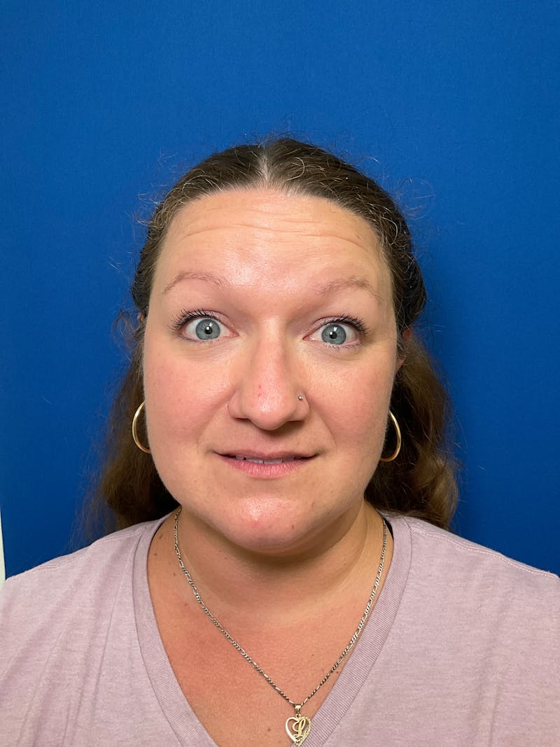 Kellee Murray, DNP Before & After Gallery - Patient 146222241 - Image 3