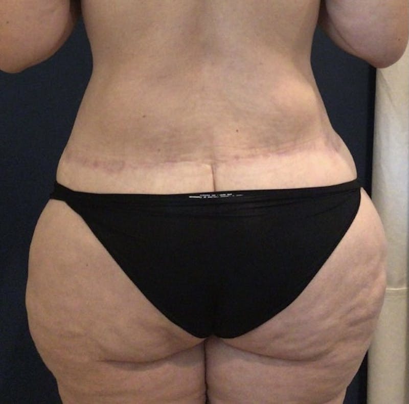 Tummy Tuck Before & After Gallery - Patient 168962875 - Image 4