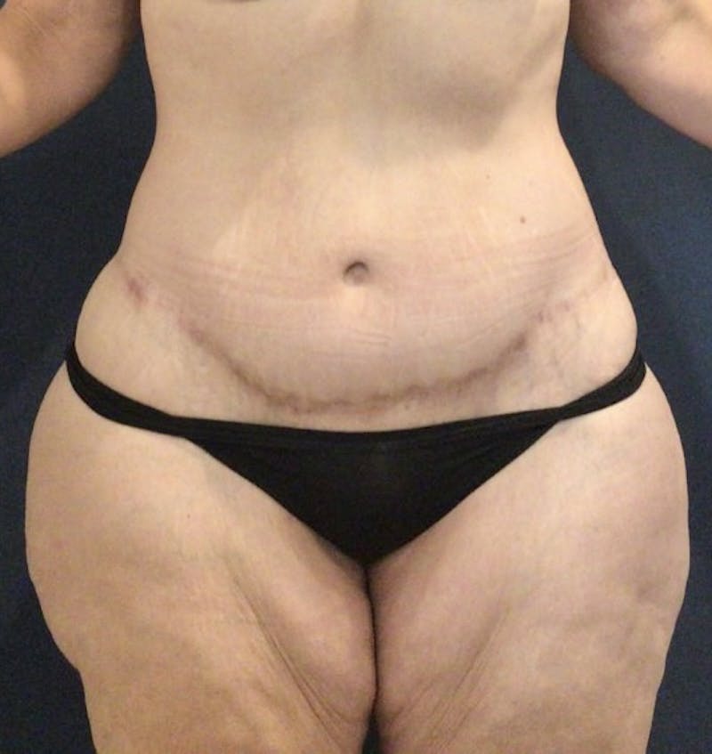 Tummy Tuck Before & After Gallery - Patient 168962875 - Image 2