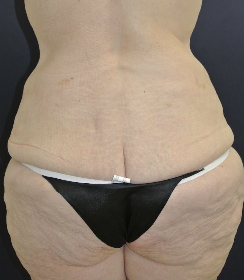 Tummy Tuck Before & After Gallery - Patient 168962875 - Image 3