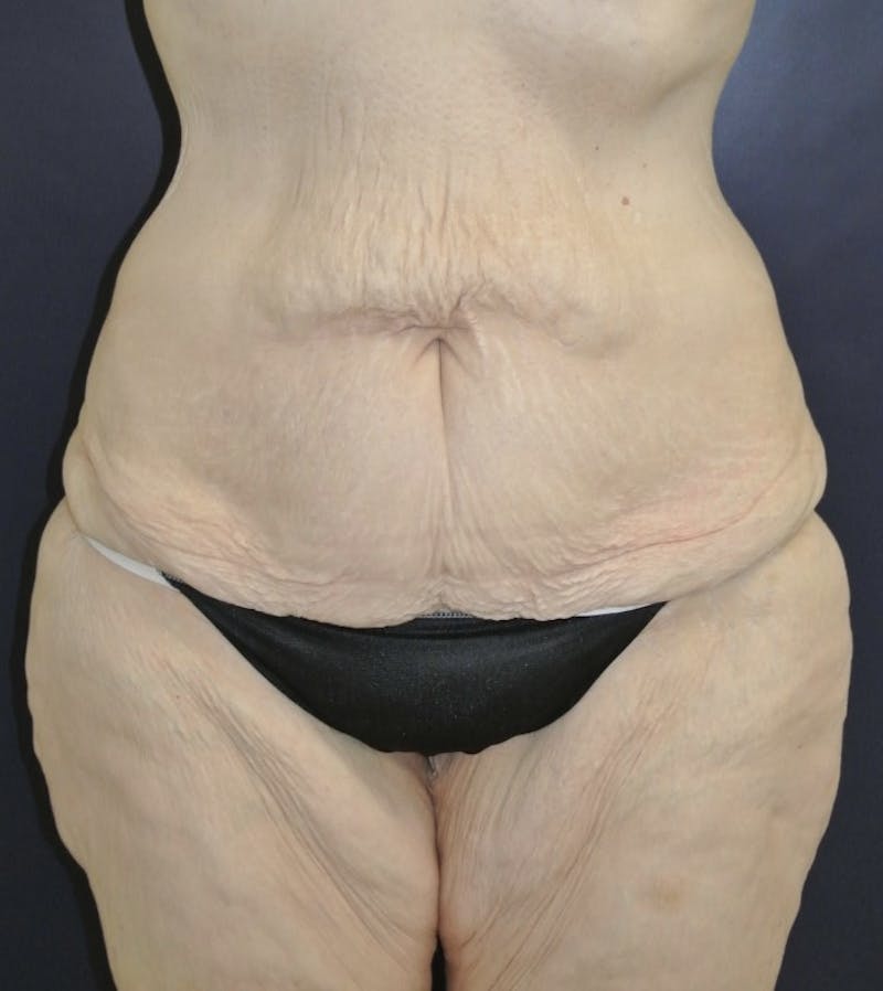 Tummy Tuck Before & After Gallery - Patient 168962875 - Image 1