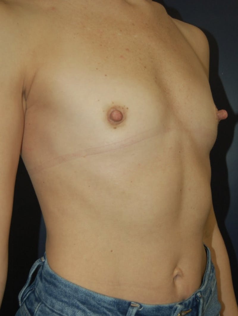 Dr. Robert Burk Before & After Gallery - Patient 147084332 - Image 3