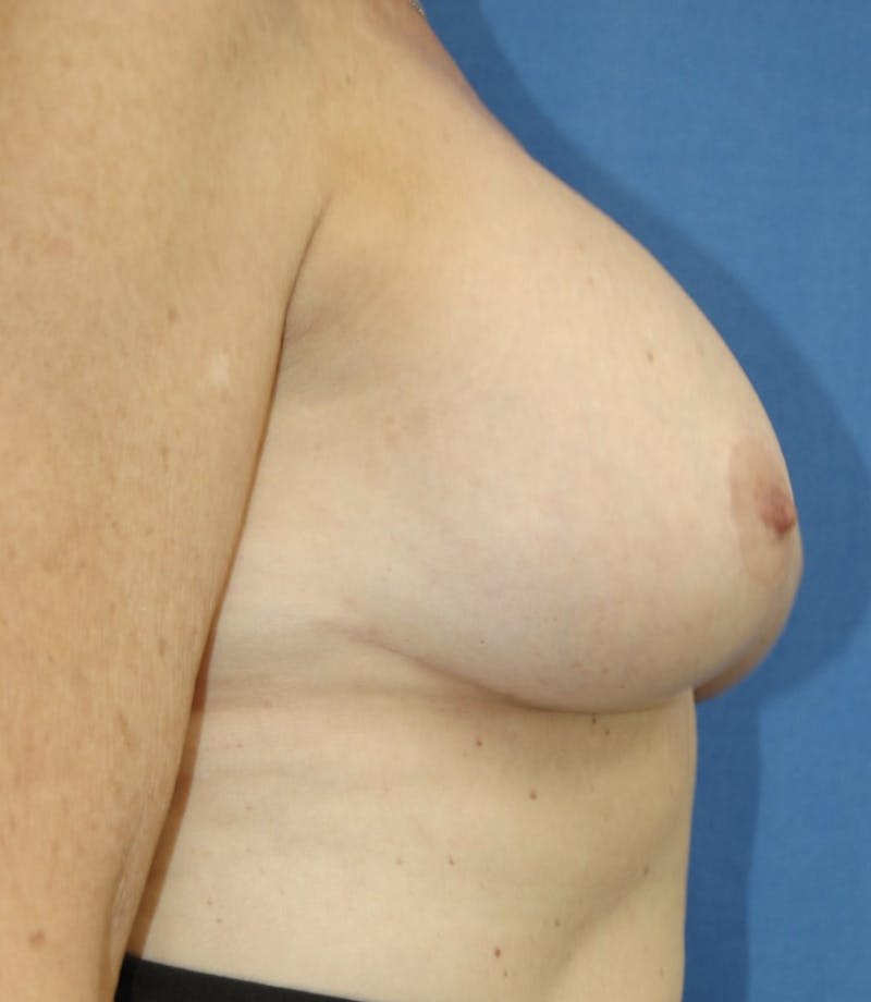 Dr. Robert Burk Before & After Gallery - Patient 147084385 - Image 6