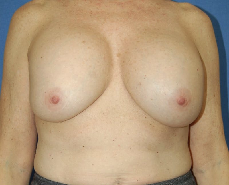 Dr. Robert Burk Before & After Gallery - Patient 147084385 - Image 1