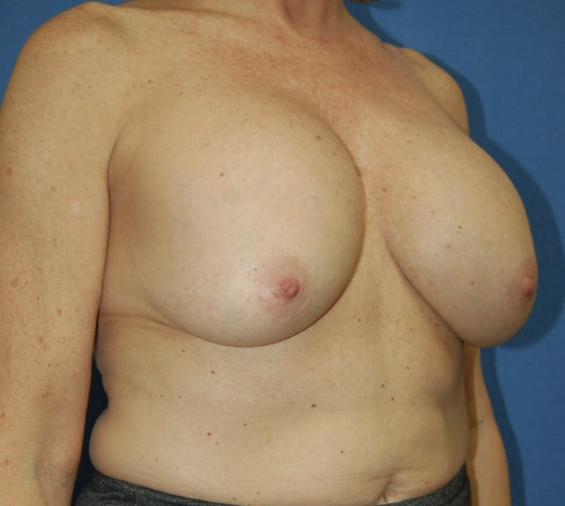 Dr. Robert Burk Before & After Gallery - Patient 147084385 - Image 3