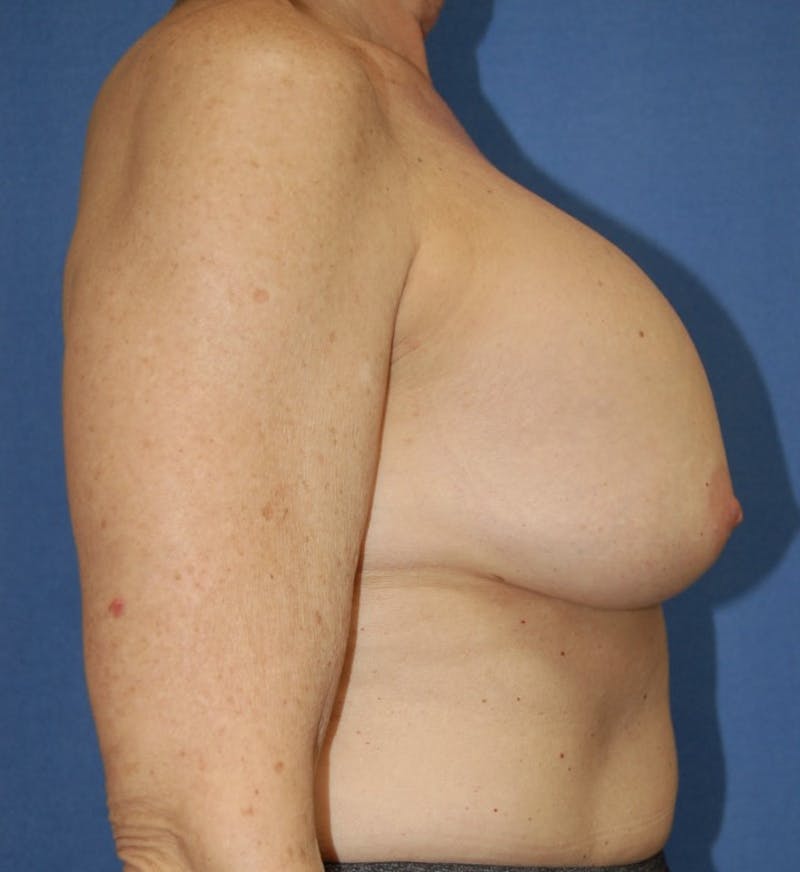 Dr. Robert Burk Before & After Gallery - Patient 147084385 - Image 5