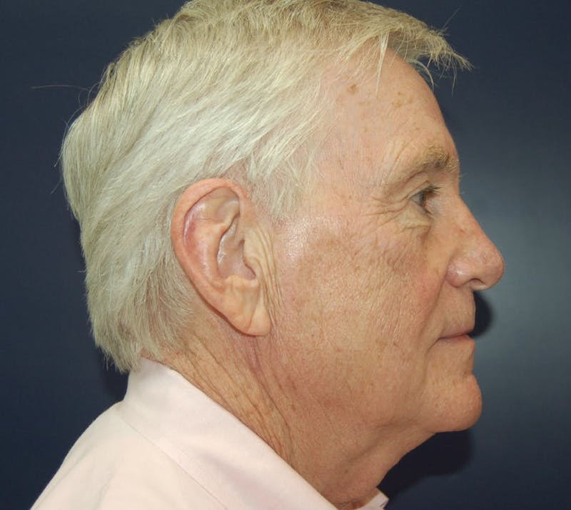 Dr. Robert Burk Before & After Gallery - Patient 147084389 - Image 4