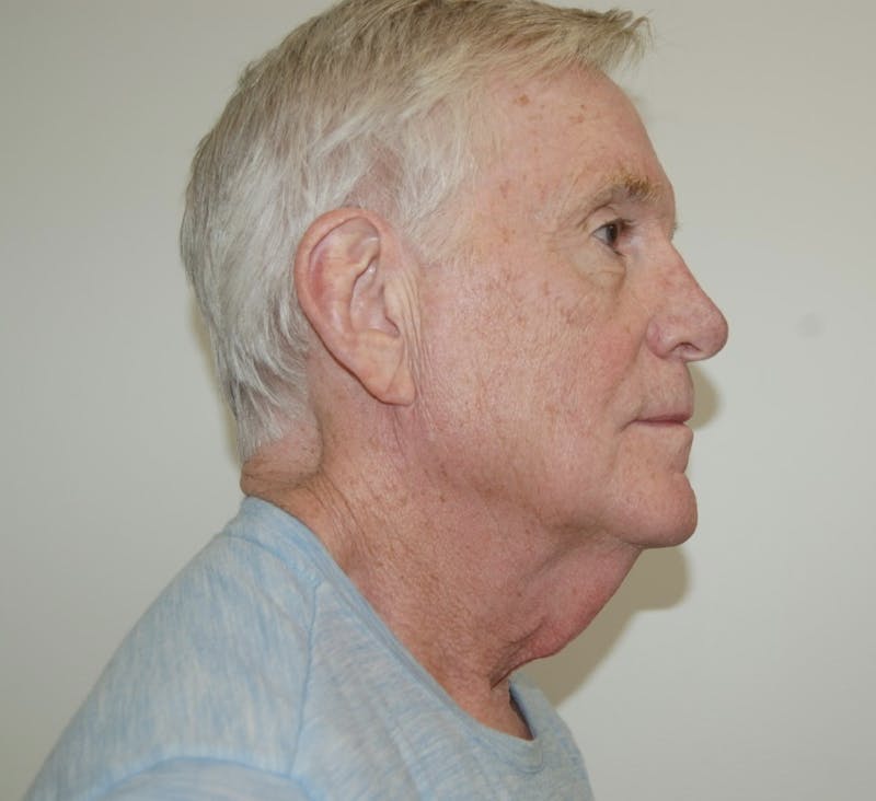 Dr. Robert Burk Before & After Gallery - Patient 147084389 - Image 3