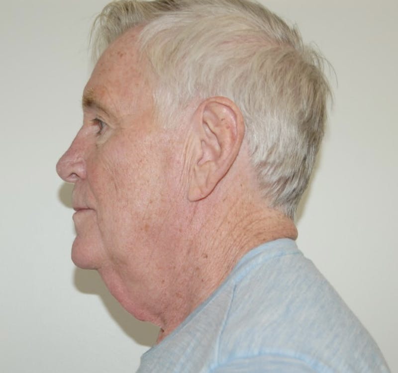 Dr. Robert Burk Before & After Gallery - Patient 147084389 - Image 5