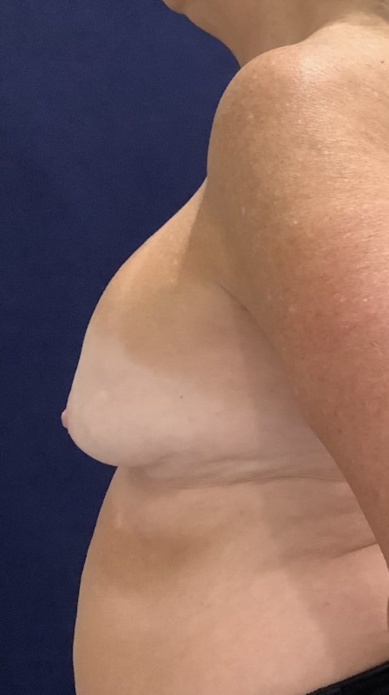 Dr. Ellen Hancock Before & After Gallery - Patient 147084462 - Image 7