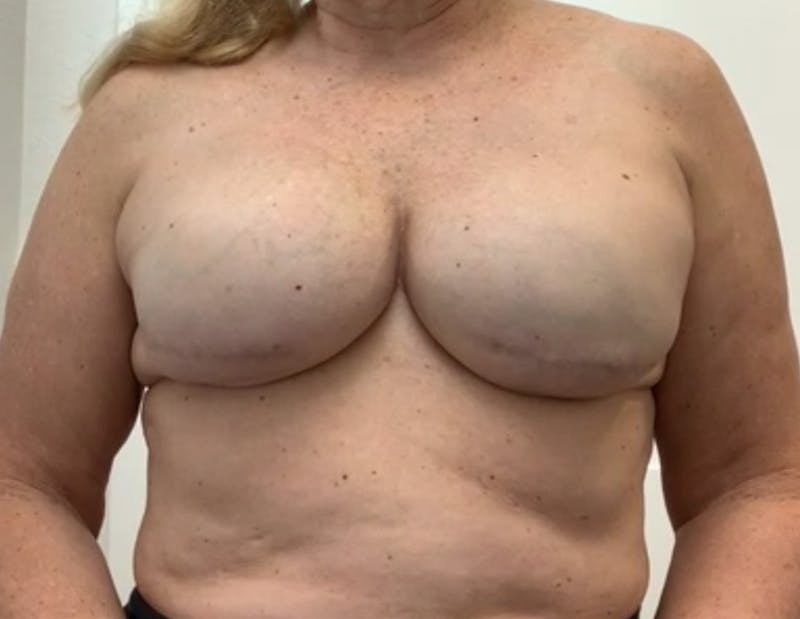 Breast Reconstruction Before & After Gallery - Patient 148035781 - Image 2
