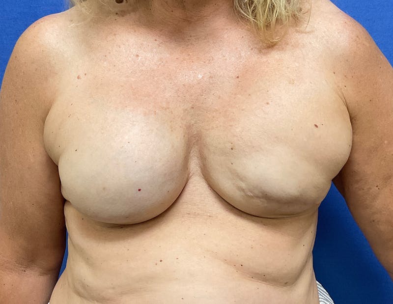 Breast Reconstruction Before & After Gallery - Patient 148035781 - Image 1