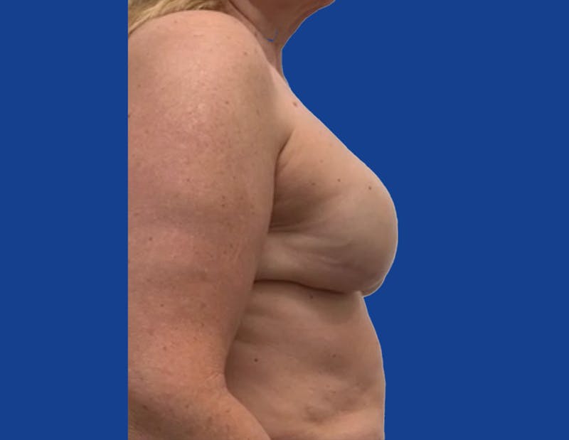 Breast Reconstruction Before & After Gallery - Patient 148035781 - Image 4