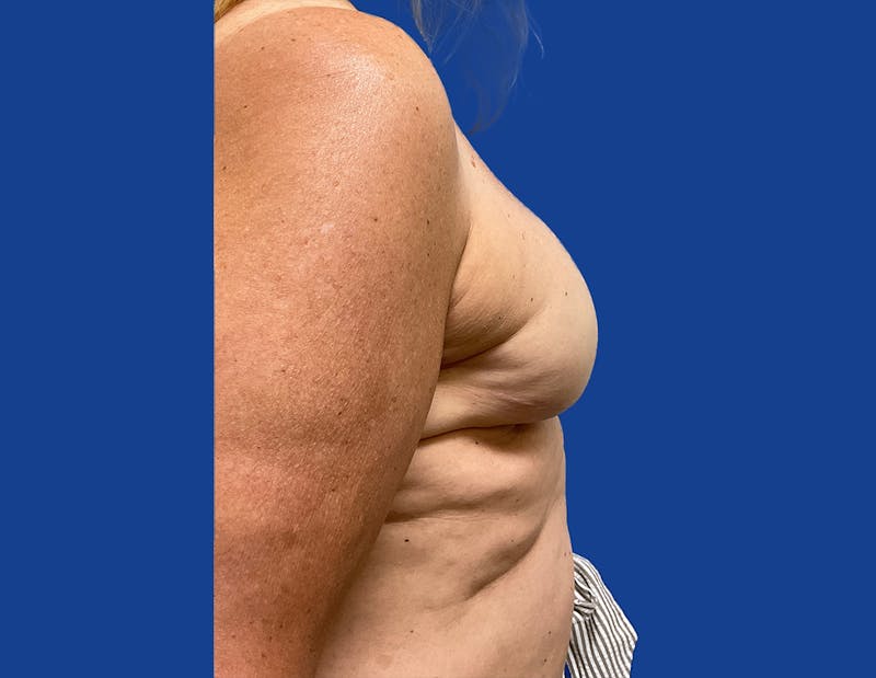 Breast Reconstruction Before & After Gallery - Patient 148035781 - Image 3