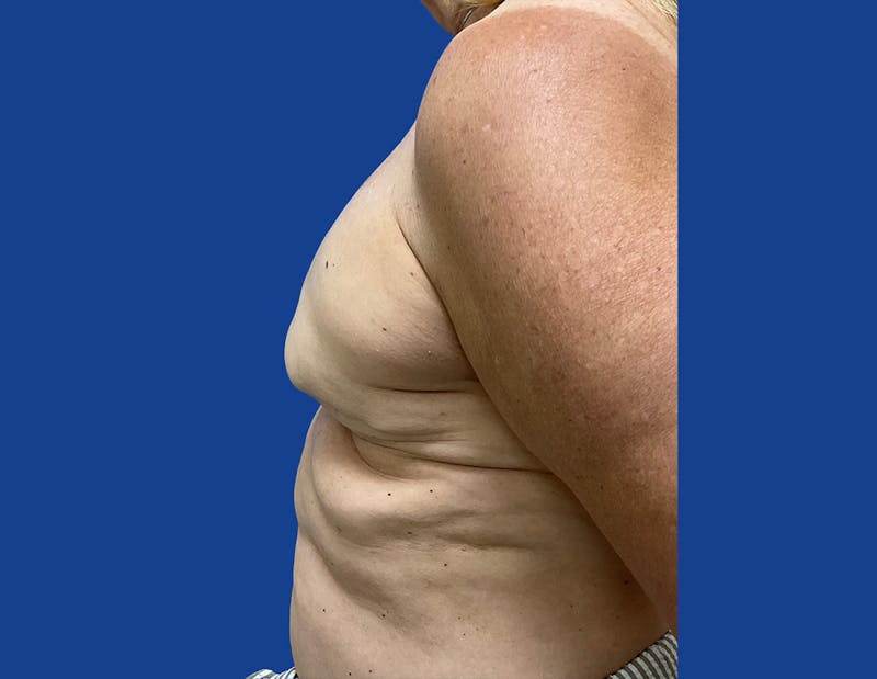 Breast Reconstruction Before & After Gallery - Patient 148035781 - Image 5