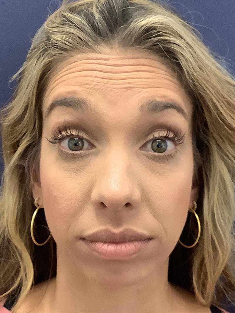 Kellee Murray, DNP Before & After Gallery - Patient 156009235 - Image 1