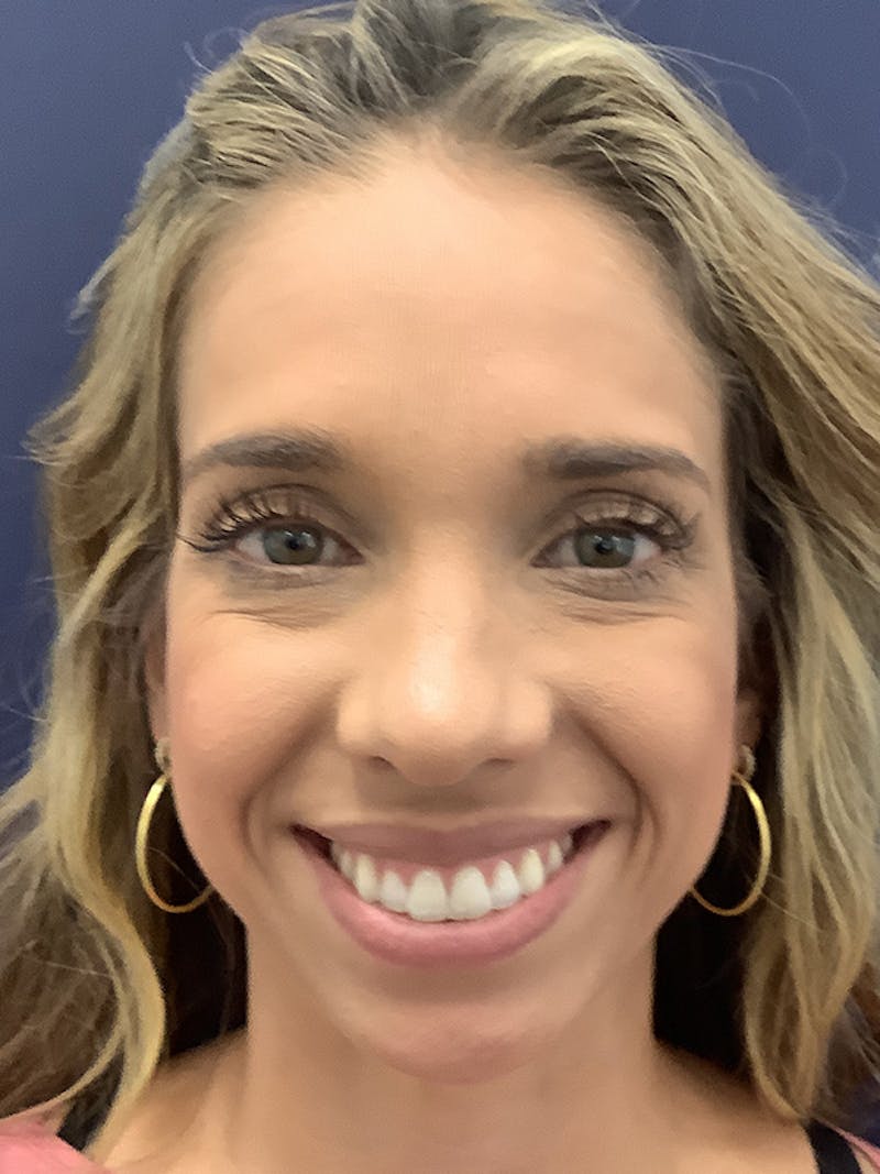 Kellee Murray, DNP Before & After Gallery - Patient 156009235 - Image 3