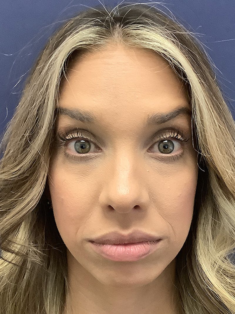 Kellee Murray, DNP Before & After Gallery - Patient 156009235 - Image 2