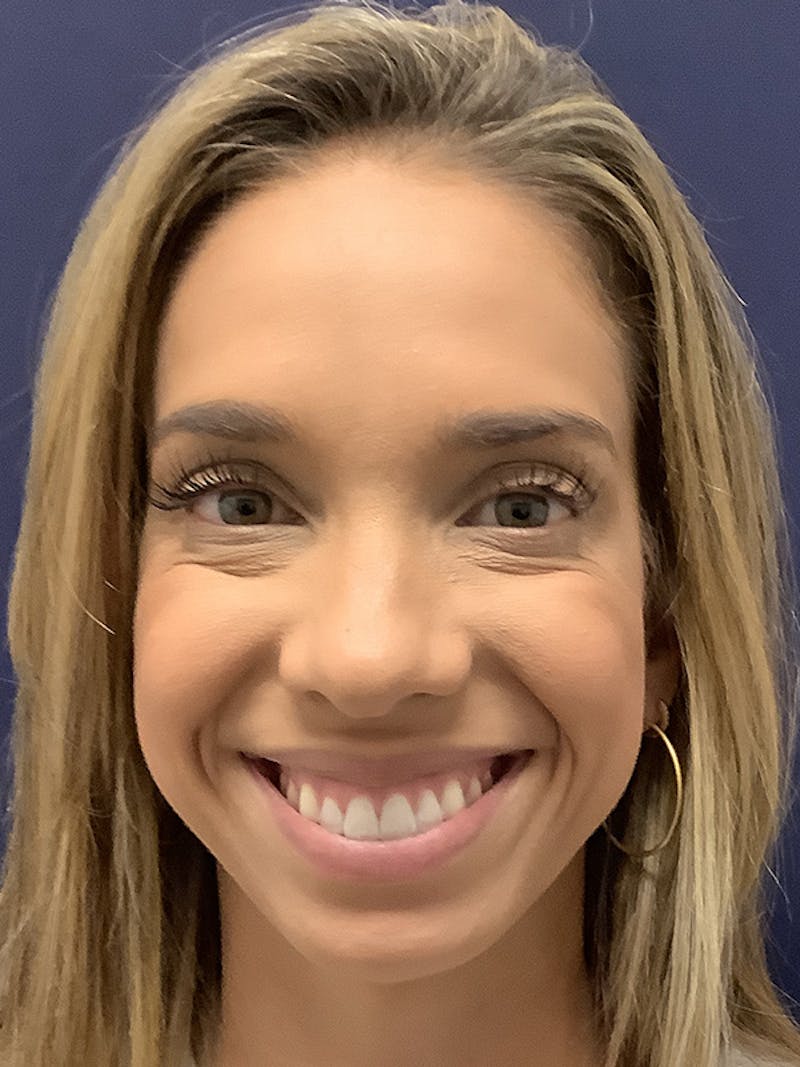 Kellee Murray, DNP Before & After Gallery - Patient 156009235 - Image 4