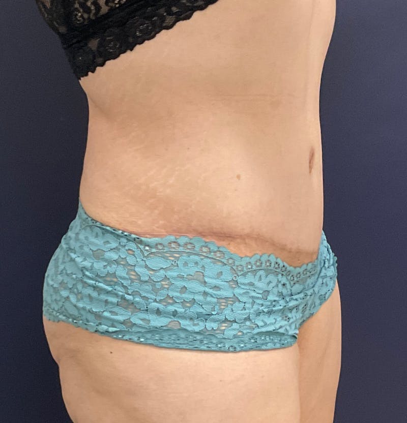 Tummy Tuck Before & After Gallery - Patient 168962874 - Image 4