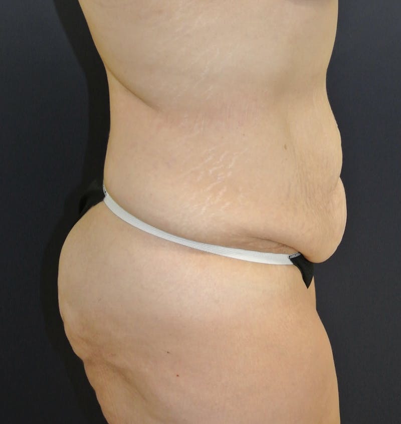Tummy Tuck Before & After Gallery - Patient 168962874 - Image 3
