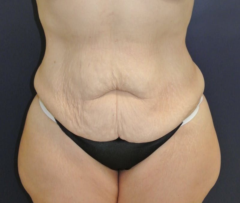 Tummy Tuck Before & After Gallery - Patient 168962874 - Image 1