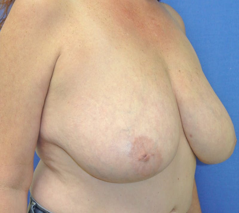 Dr. Chris Bates Before & After Gallery - Patient 169291655 - Image 3