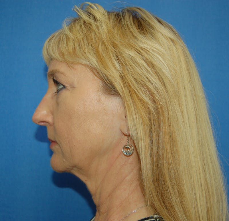 Dr. Robert Burk Before & After Gallery - Patient 297443 - Image 3
