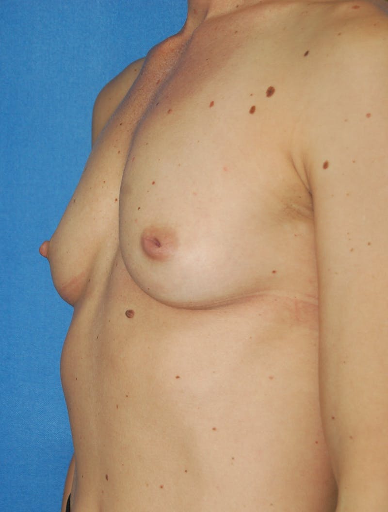 Dr. Robert Burk Before & After Gallery - Patient 248253 - Image 3