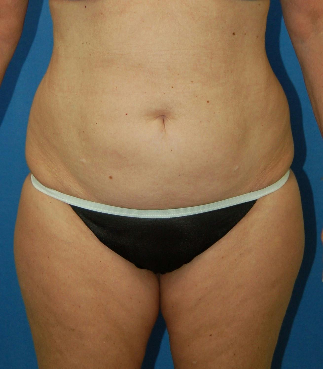 Dr. Robert Burk Before & After Gallery - Patient 213280 - Image 1