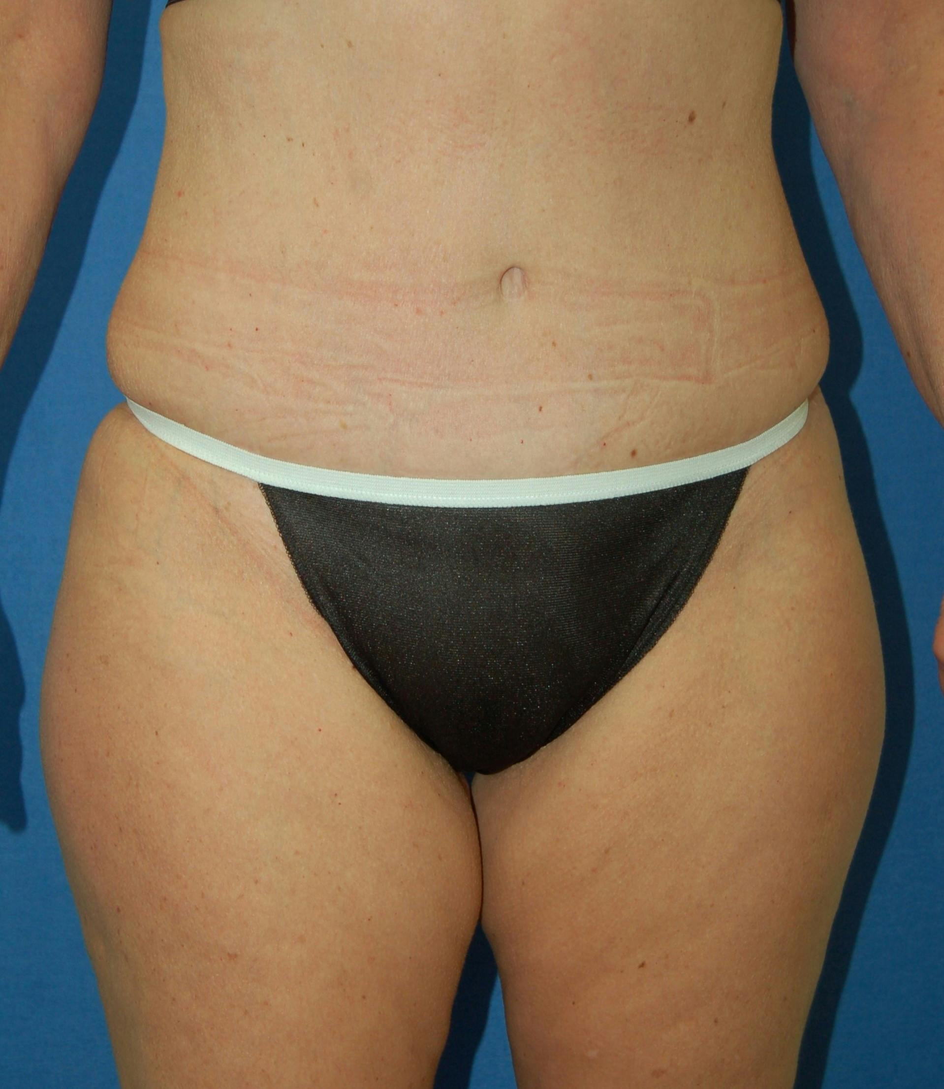 Dr. Robert Burk Before & After Gallery - Patient 213280 - Image 2