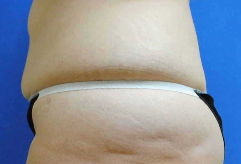 Dr. Robert Burk Before & After Gallery - Patient 402608 - Image 7