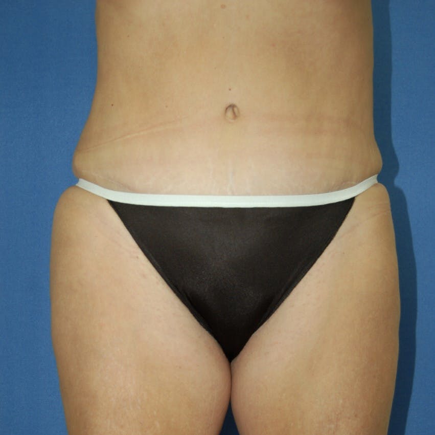 Dr. Robert Burk Before & After Gallery - Patient 106847 - Image 2