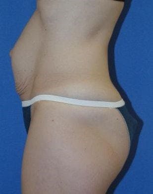 Dr. Robert Burk Before & After Gallery - Patient 114464 - Image 1