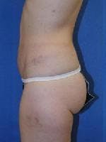 Dr. Robert Burk Before & After Gallery - Patient 533524 - Image 2