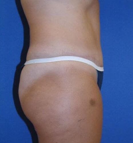 Dr. Robert Burk Before & After Gallery - Patient 233432 - Image 2