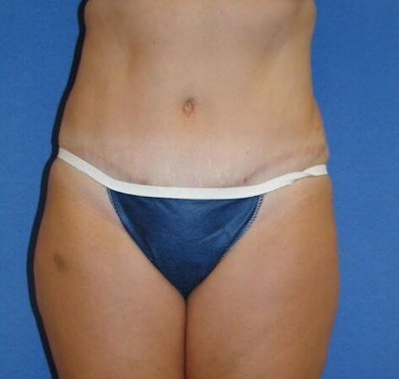 Dr. Robert Burk Before & After Gallery - Patient 233432 - Image 6