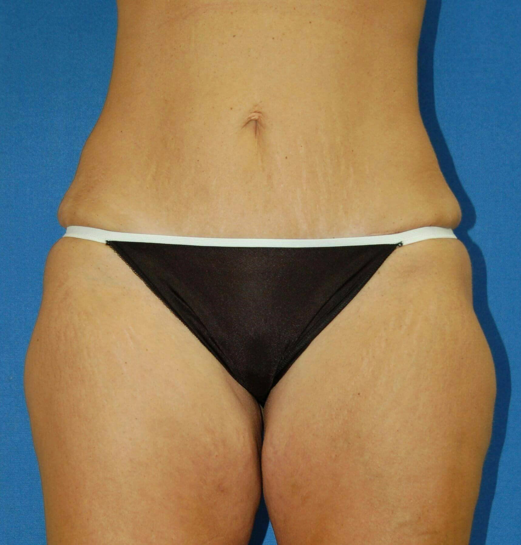 Dr. Robert Burk Before & After Gallery - Patient 906143 - Image 2