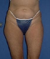 Dr. Robert Burk Before & After Gallery - Patient 323712 - Image 1