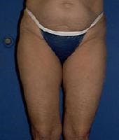 Dr. Robert Burk Before & After Gallery - Patient 323712 - Image 2