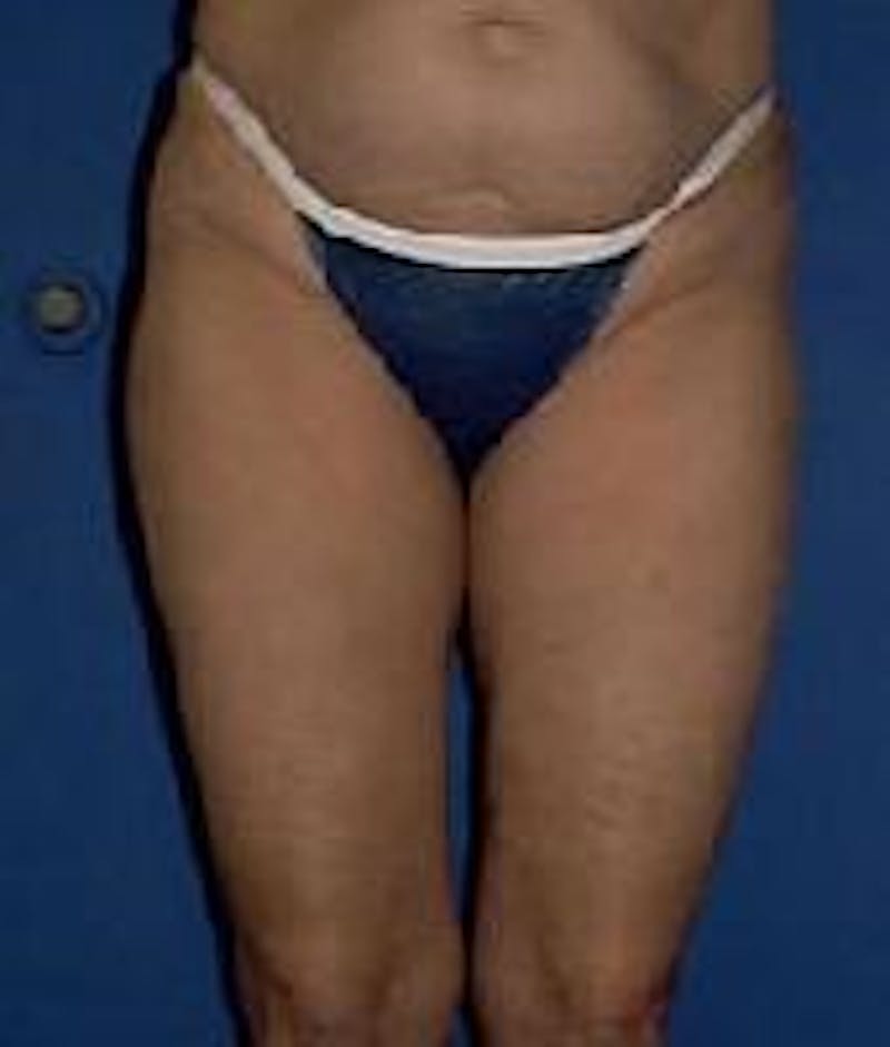 Dr. Robert Burk Before & After Gallery - Patient 323712 - Image 4