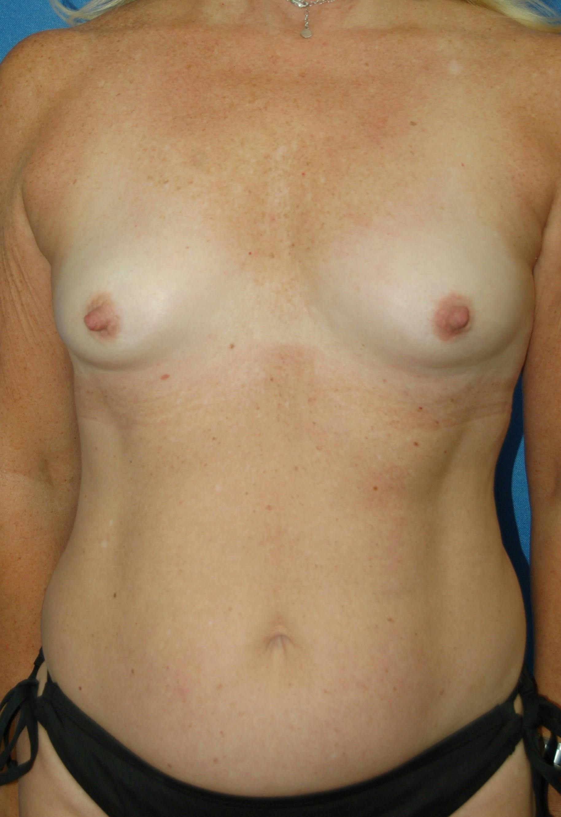 Dr. Robert Burk Before & After Gallery - Patient 208172 - Image 1