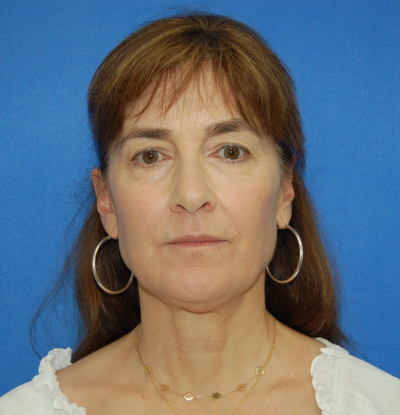 Dr. Robert Burk Before & After Gallery - Patient 375424 - Image 1