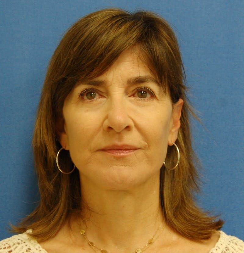 Dr. Robert Burk Before & After Gallery - Patient 375424 - Image 2