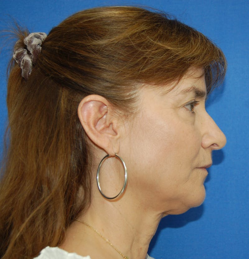 Dr. Robert Burk Before & After Gallery - Patient 375424 - Image 3