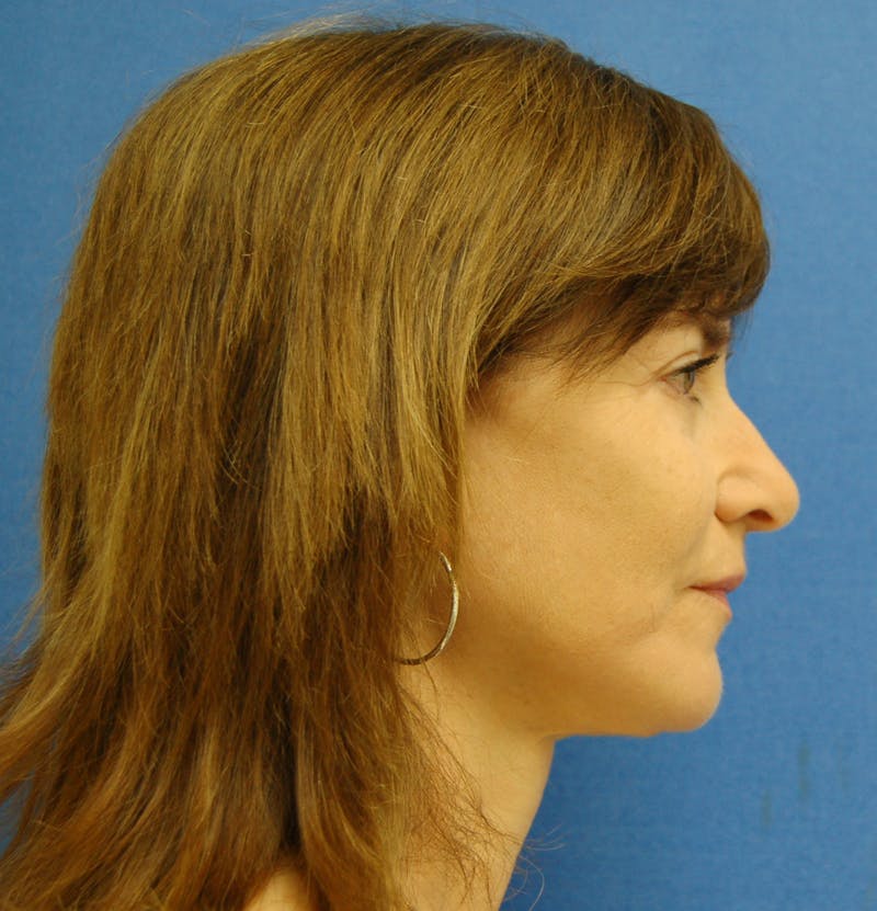 Dr. Robert Burk Before & After Gallery - Patient 375424 - Image 4